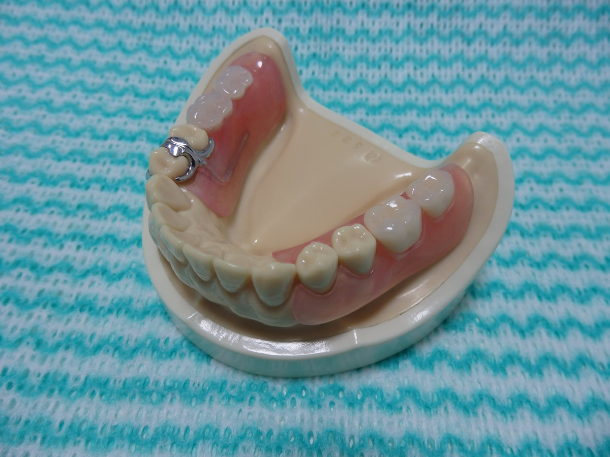 ノンクラスプデンチャー