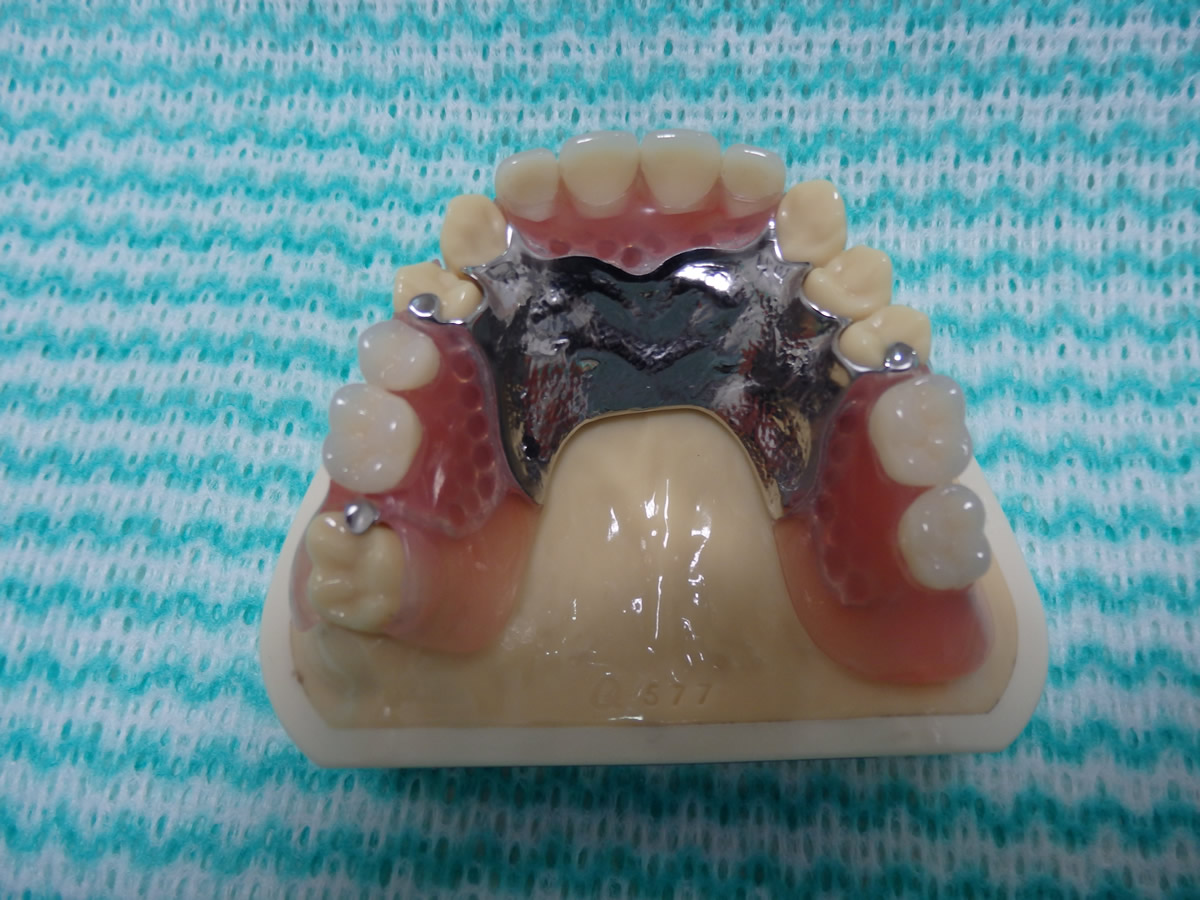 ノンクラスプ金属床